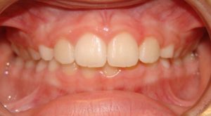 Corrected Front Crossbite by Orthodontist Dwight Buelow
