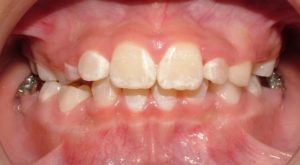 Corrected Impacted Front Tooth, Orthodontic Treatment by Dwight V Buelow, DDS, MS