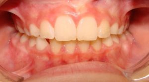 Corrected upper narrow jawbone by orthodontist Dwight V Buelow
