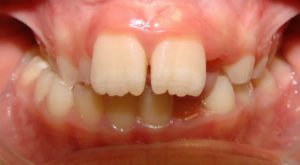 Narrow Upper Jawbone, Pre-Orthodontic Treatment with Dwight V. Buelow, DDS, MS 