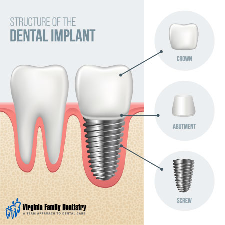 Structure of a dental implant | Virginia Family Dentistry
