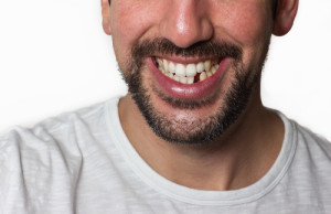 5 ways to replace a missing tooth