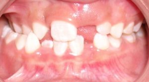Impacted Front Tooth Pre-Orthodontic Treatment with Dwight V Buelow