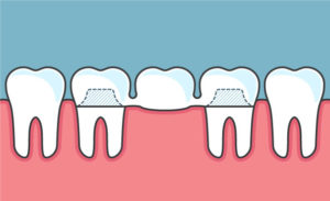 Dental Bridge Illustration