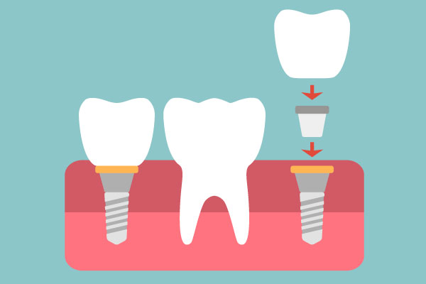 Virginia Family Dentistry Dental Implant Illustration