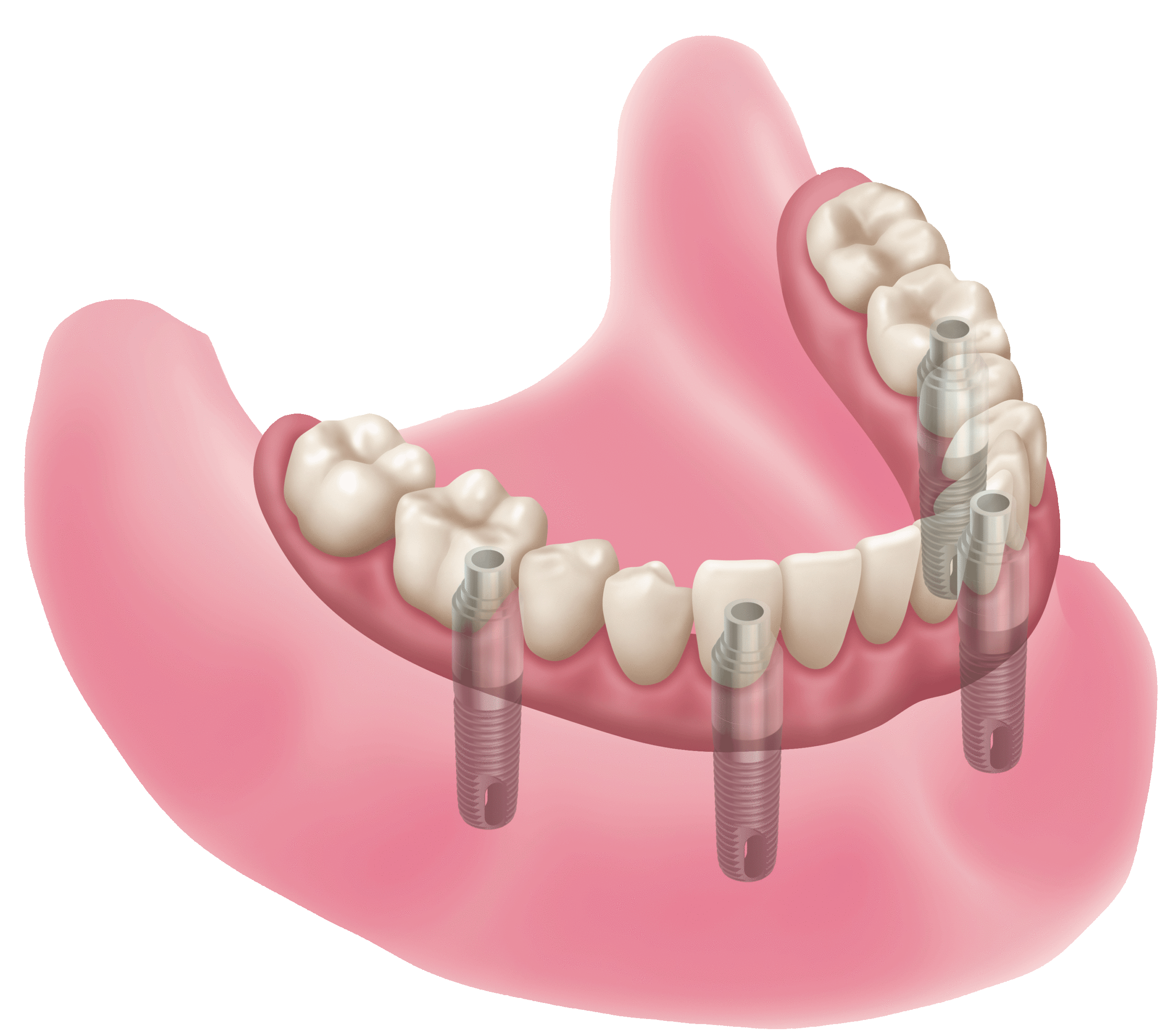 Implant Supported Hybrid Denture at Virginia Family Dentistry