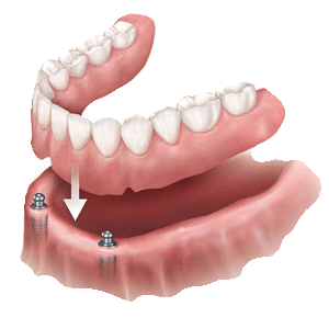 Dental Implant Supported Overdenture at Virginia Family Dentistry