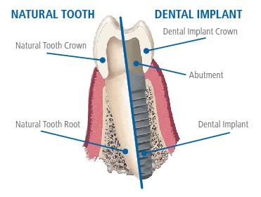 Anatomy of a dental implant